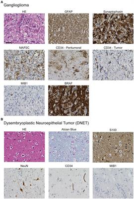 Long-term seizure outcome after epilepsy surgery of neuroglial tumors